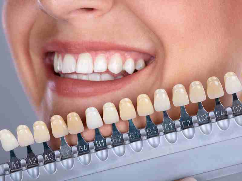 Veneers vs Whitening: Which One Gives Better Long-Term Results?