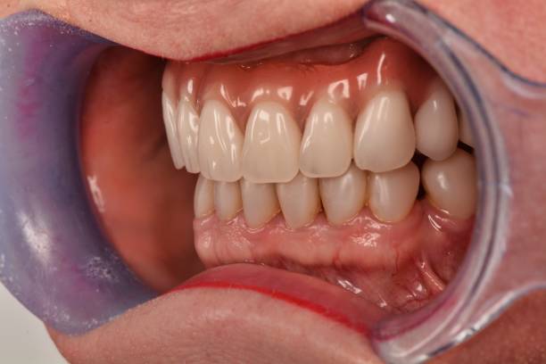 How Full Mouth Implants Can Completely Restore Your Smile – Telegraph
